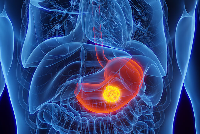 慢性胃炎のイメージイラスト